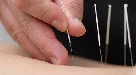 Treatment by acupuncture. The doctor uses needles for treatment of the patient.