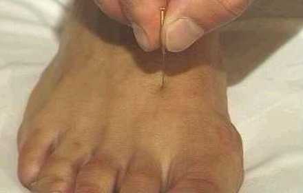 Akupunktur - Fuß